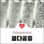 골다공증(Osteoporosis) 정의와 설명, 원인과 증상, DXA 초음파 CT T-Score 검사 진단 및 여성호르몬 흡수억제제 등 약물치료와 내부고정술과 인공관절술 등 수술