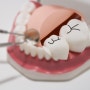 성인 치아 홈 메우기 충치 예방에 도움을?