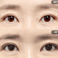 세모눈은 어떻게 개선할까?(+함몰눈,처진눈)