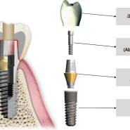 신입 치과위생사를 위한 치과술식 정리 - 임플란트 수술(1st)