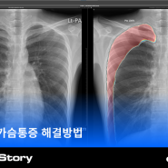 [DEEP:CHEST] 기흉, 마를 수록 위험하다고?