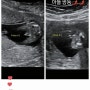 쌍둥이 임신 11주~14주 : 성별 확인, 초음파 비용, 니프티, 임신성 비염