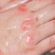 접촉성 피부염[contact dermatitis]