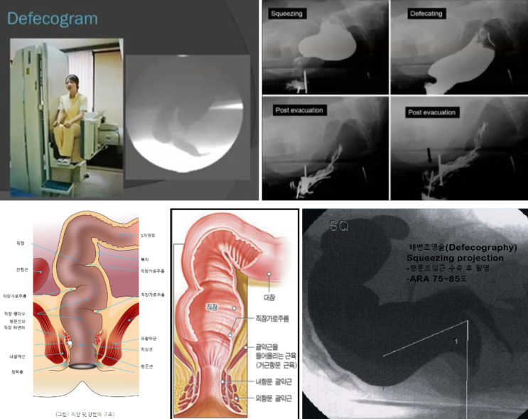 직장과 항문의 기능적 구조적 평가를 진단하는 배변조영술(Defecography) : 네이버 블로그