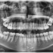 나오지 않는 어금니를 살리는 교정치료
