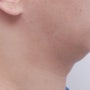 남자, 무턱 이중턱- 턱끝필러 장점과 단점, 지방이식과 비교