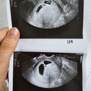 임신 6주차 심장소리 확인 두근두근 / 입덧