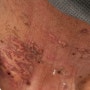두경부암 환자에서 방사선치료후 피부손상시 적절한 치료방법