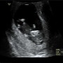임신 10주차 아기 크기, 아기 심박수, 10주 4일, 피고임 없애는 방법