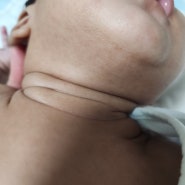 신생아 중독성홍반 2탄 자연치유과정 | 80일 아기