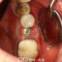신길동 치과 에서 잇몸뼈 부족할 때 임플란트 수명 늘리는 방법 (feat. i-GBR & 각화치은 늘리기)