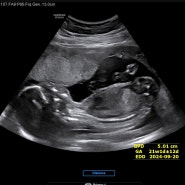 임신 20~21주차) 임신안정기 임산부태동 임산부 다리저림 임산부압박스타킹 임산부부종