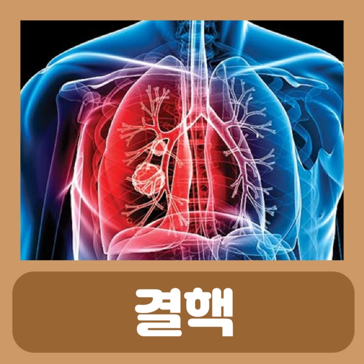 폐결핵 초기증상 결핵 증상 전염 치료 약 잠복결핵 보건소 결핵 검사 : 네이버 블로그