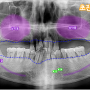 월촌역 치과 탈락한 치아를 오랜 시간 방치해둔다면 임플란트 뼈이식을 받으셔야 될 수 있습니다.