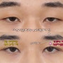 자연유착 눈매교정 쌍수 2주차 찐후기(신사역성형외과)