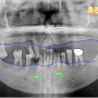 상인동 치과 임플란트 염증은 치조골을 소실시키는 원인이 될 수 있습니다. (임플란트 뼈이식을 통해 해결)