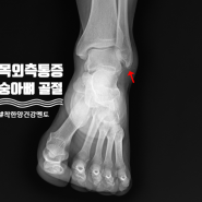 발목 외측 복숭아뼈 통증 distal fibular fracture 보호대 또는 수술