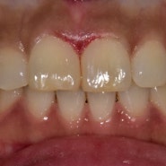 상현동 치과 앞니 심미레진 치료