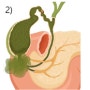 외래에서 진단된 급성 무결석 담낭염
