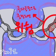 골다공증 원인 병원에서 찾고 예방하자