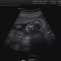 [임신기록5] 임신중기_17주~20주 안정기, 입덧완화, 운동시작