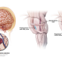 뇌간 해면혈관종 (Brainstem Cavernous Malformation)