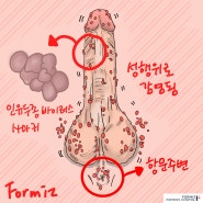 인유두종 바이러스 치료 고위험군 사마귀 방지하기