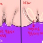 대음순수술 미백 + 늘어짐 볼륨 성형 가능한곳