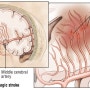 허혈성 뇌졸중 (Ischemic stroke)-Part1