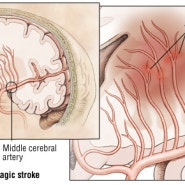 허혈성 뇌졸중 (Ischemic stroke)-Part1