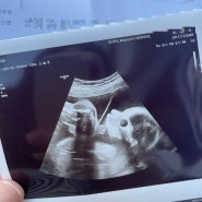 임신일기 16. 24주 임당검사, 쌍둥이 배크기, 대전 서울여성병원