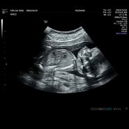 [임신일기] 임신 16-19주차 증상 기록✏ | 이탈리아 태교여행 | 2차 기형아검사 | 첫태동과 태담❣️ | 임신성여드름 관리중 | 골반가슴통증