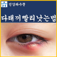 속 다래끼빨리낫는법 눈밑 다래끼 초기증상 눈다래끼 전염 원인