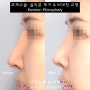 실리콘 제거 + 콧구멍 비대칭 교정 : 코재수술 사례 분석 【Dr. 아베크 코성형】