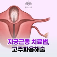 자궁근종치료법, 자궁근종용해술
