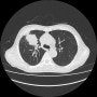 [하남건강검진] 폐암의 증상 // 70대 남성 폐암 진단 케이스(기침, 식욕부진, 체중감소)