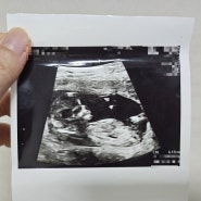 난임일기 1탄) 부산 세화병원6과: 임신 포기할 뻔한 난임부부의 시험관2차 임신성공 후기: 4일배양 신선이식