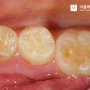 소하동 치과 어금니 충치 치료 레진 보험 적용한 소아치료 사례