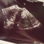 임신이야기 - 5주 3일 아기집 확인, 임신확인증, 임산부 등록, 산모검사