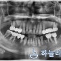 인천구강악안면외과, 잇몸뼈 부족으로 상악동거상술을 동반한 상악구치부의 임플란트 수복 케이스