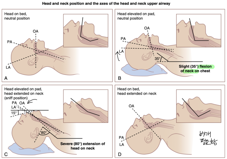 Intubation, sniff position : 네이버 블로그