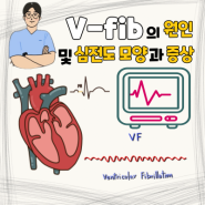 심실세동(V-fib) 원인과 심실세동 심전도 모양 및 V-fib 증상 그리고 치료