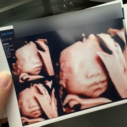 [임신] 25주 4일, 입체초음파, 임신성당뇨검사