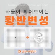 사물이 휘어보이는 황반변성 증상과 원인 및 자가 진단 방법[대전둔산동안과 삼성스마일안과]