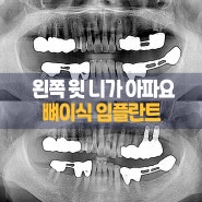 수원 임플란트 잘하는 치과 에서 브릿지 치아 중 문제 치아만 치료했습니다