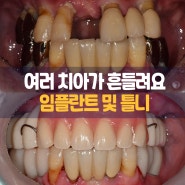 매탄권선역 치과 다수 치아 흔들림, 최소 임플란트 식립 및 부분 틀니 증례