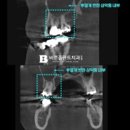 구강외과 교수 출신 원장이 진료하는 인천 자동차 보험 치과 에서 턱관절과 임플란트 치료를 한 번에!😮