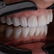 치아 욱신 증상은 왜 나타나는 걸까요?