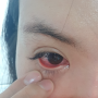 안구건조증 증상인 눈 충혈 해결 방법은?