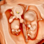 임신기록 / 12주~16주 기록, 12주 목투명대검사, 1차기형아검사 입체초음파로 만난 둥이들.
